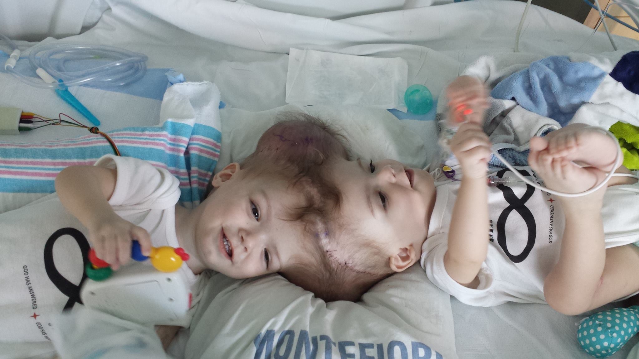 Conjoined twins Jadon and Anias before their life-changing surgery