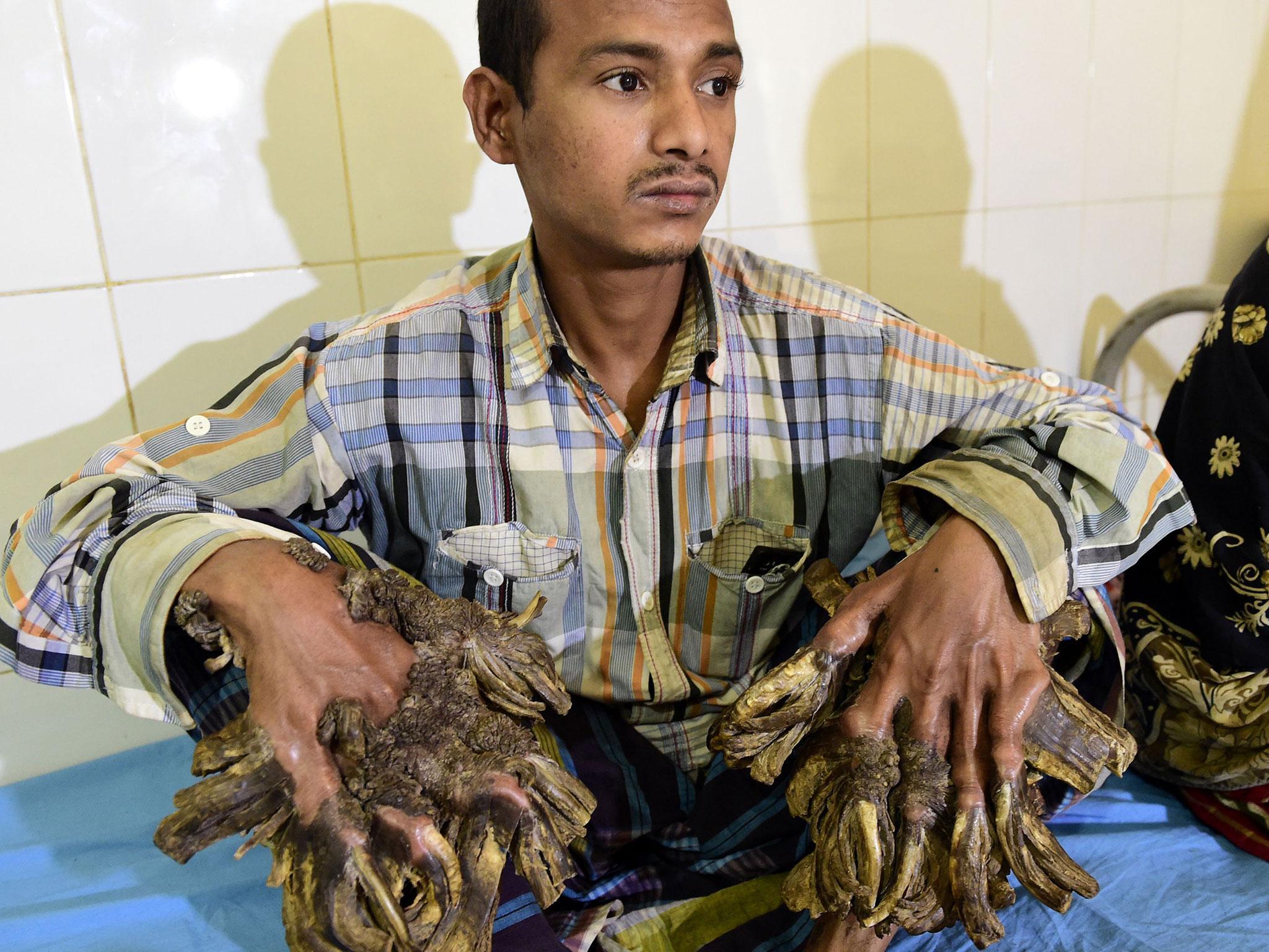 Abul Bajandar prior to surgery to remove the large warts from his body