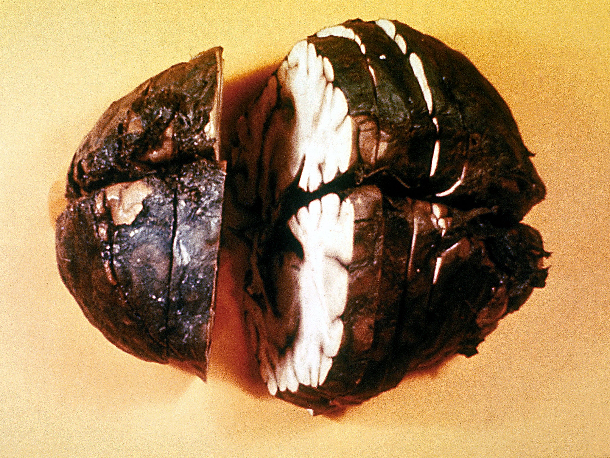 A brain specimen shows haemorrhagic meningitis caused by inhaling anthrax