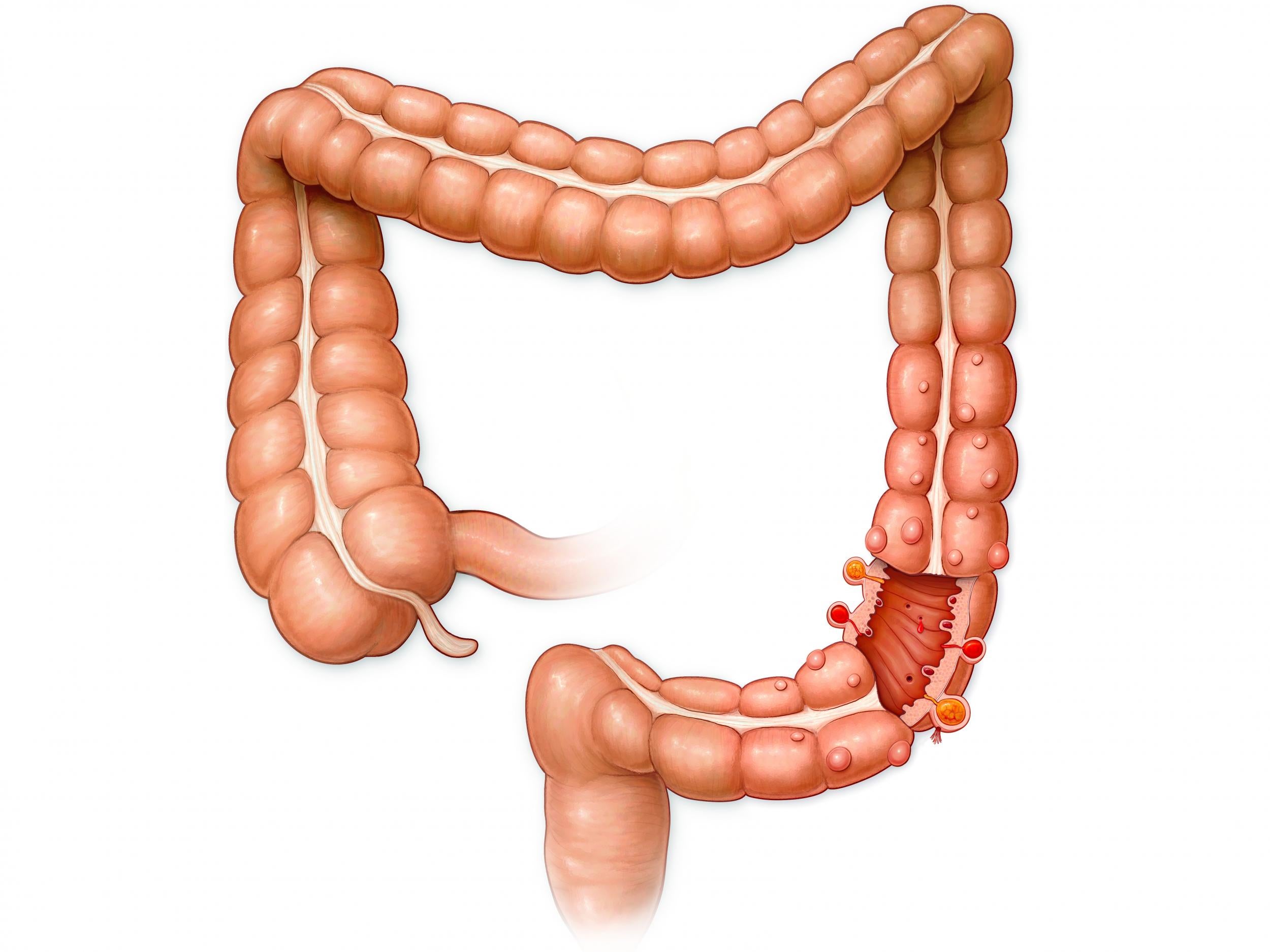 A diagram of the large intestine with the appendix visible on the left hand side