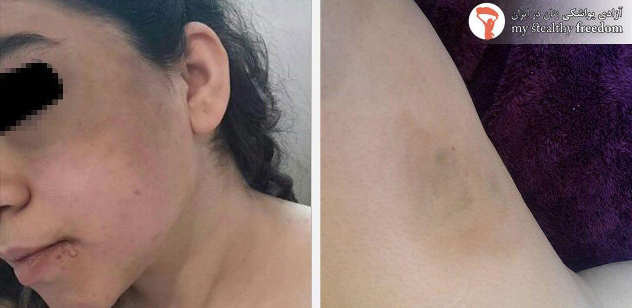 Photos of injuries suffered by a 14-year-old girl at the hands of morality police in Iran