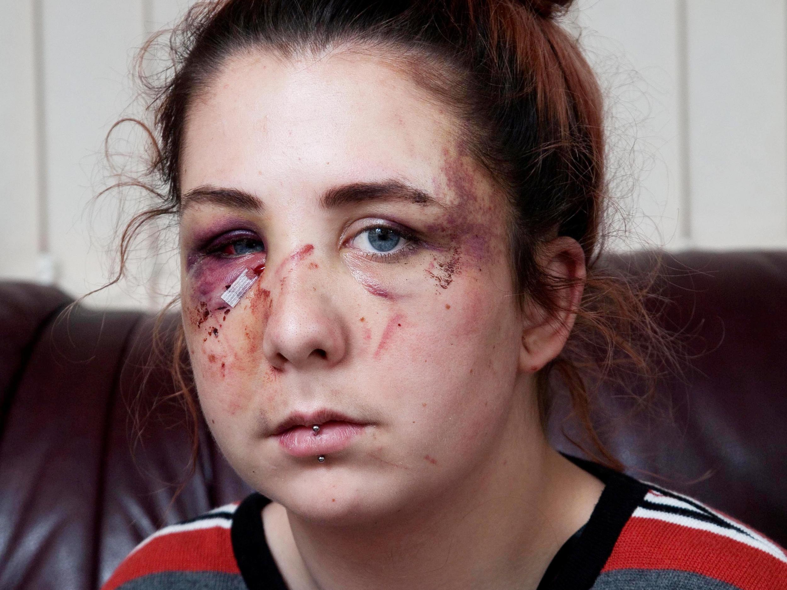 Teenager left permanently disfigured after attack