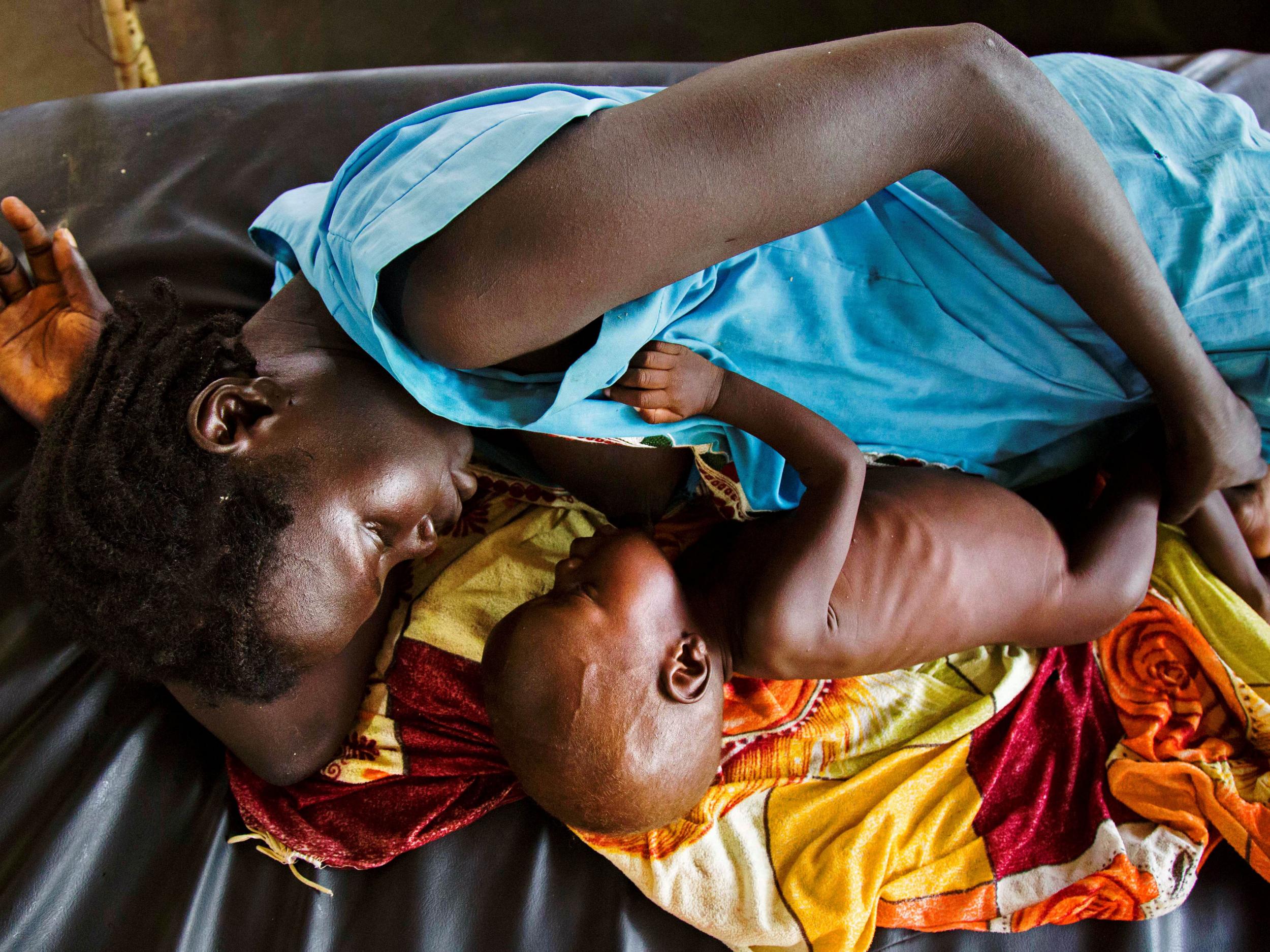 A mother breastfeeds her child, who is suffering from acute malnutrition, at a Doctors without Borders clinic in South Sudan