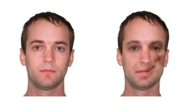 Participants in a study showed negative discrimination when confronted with a picture of a disfigured face