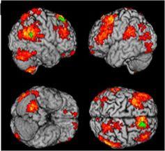 Grey matter patterns in depression