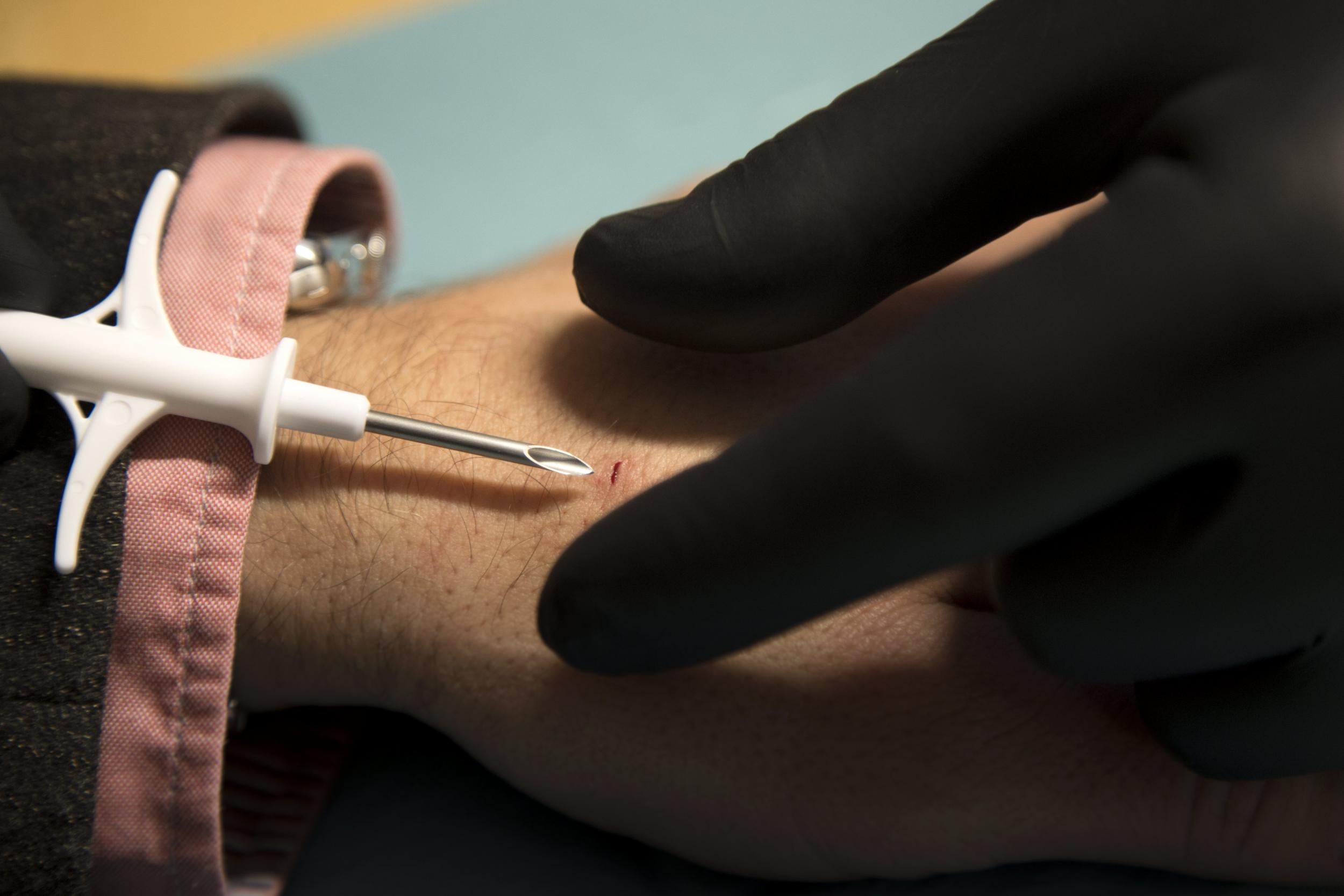 A volunteer getting a chip implanted in his hand