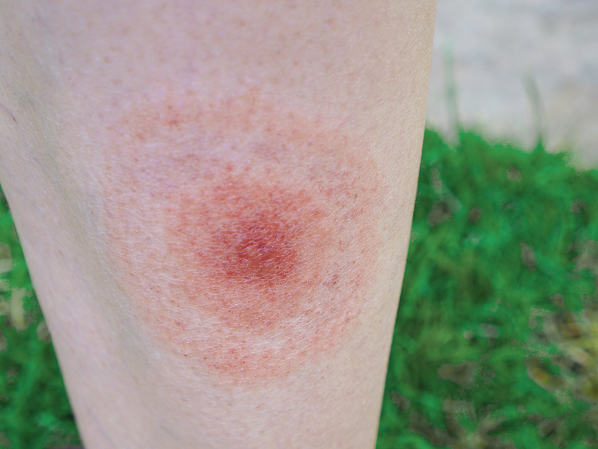 Lyme disease