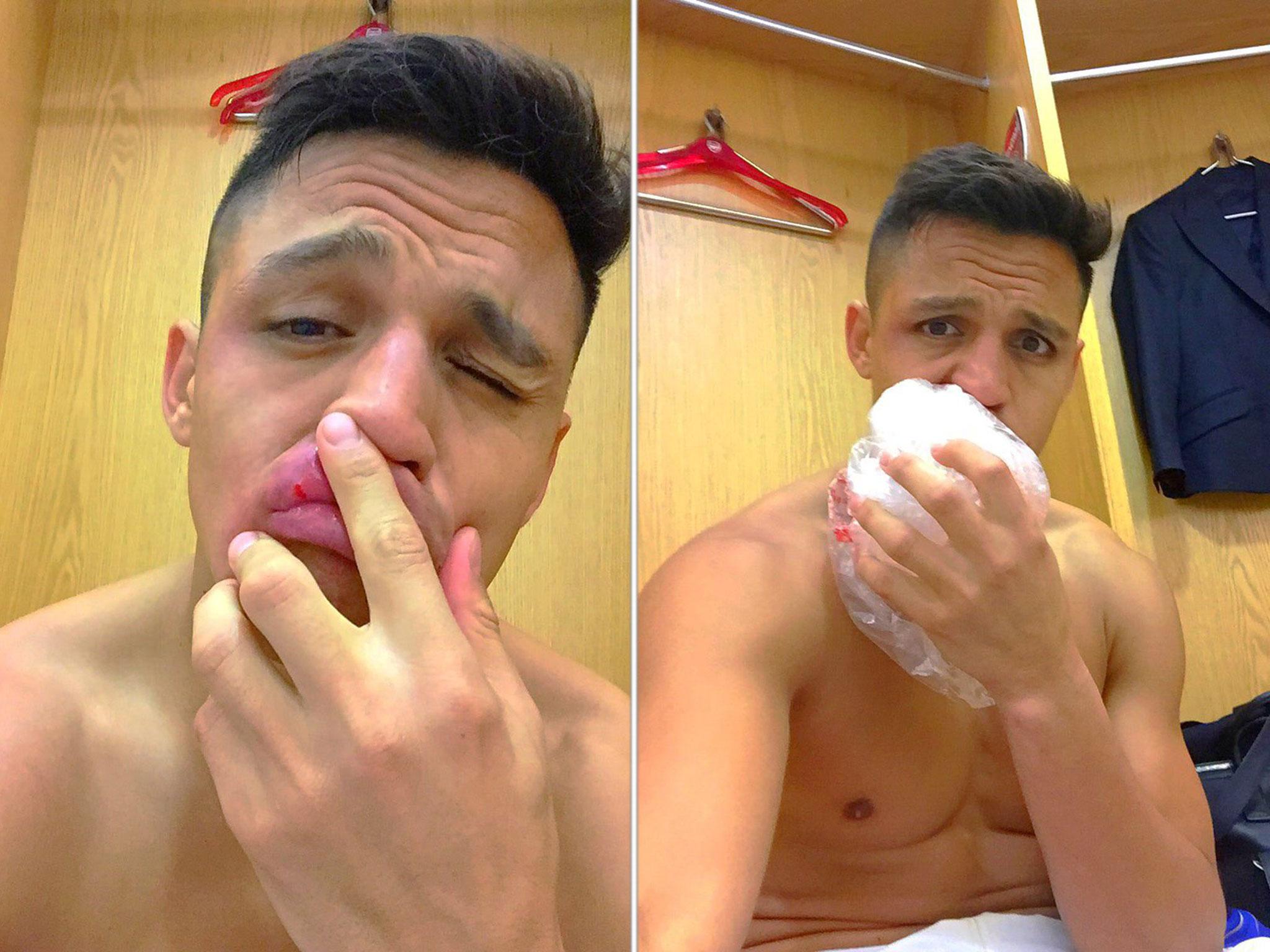 Alexis Sanchez posted two pictures from the Arsenal changing room after cutting his lip during the win over Leicester