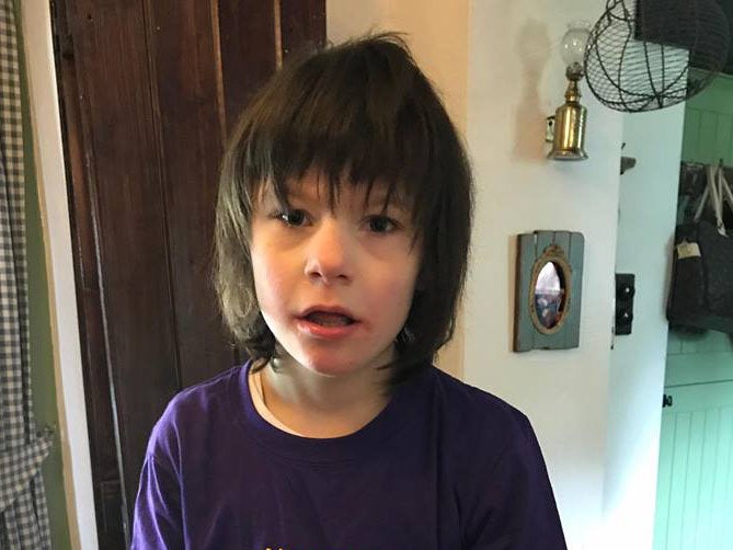 Billy Caldwell has severe epilepsy