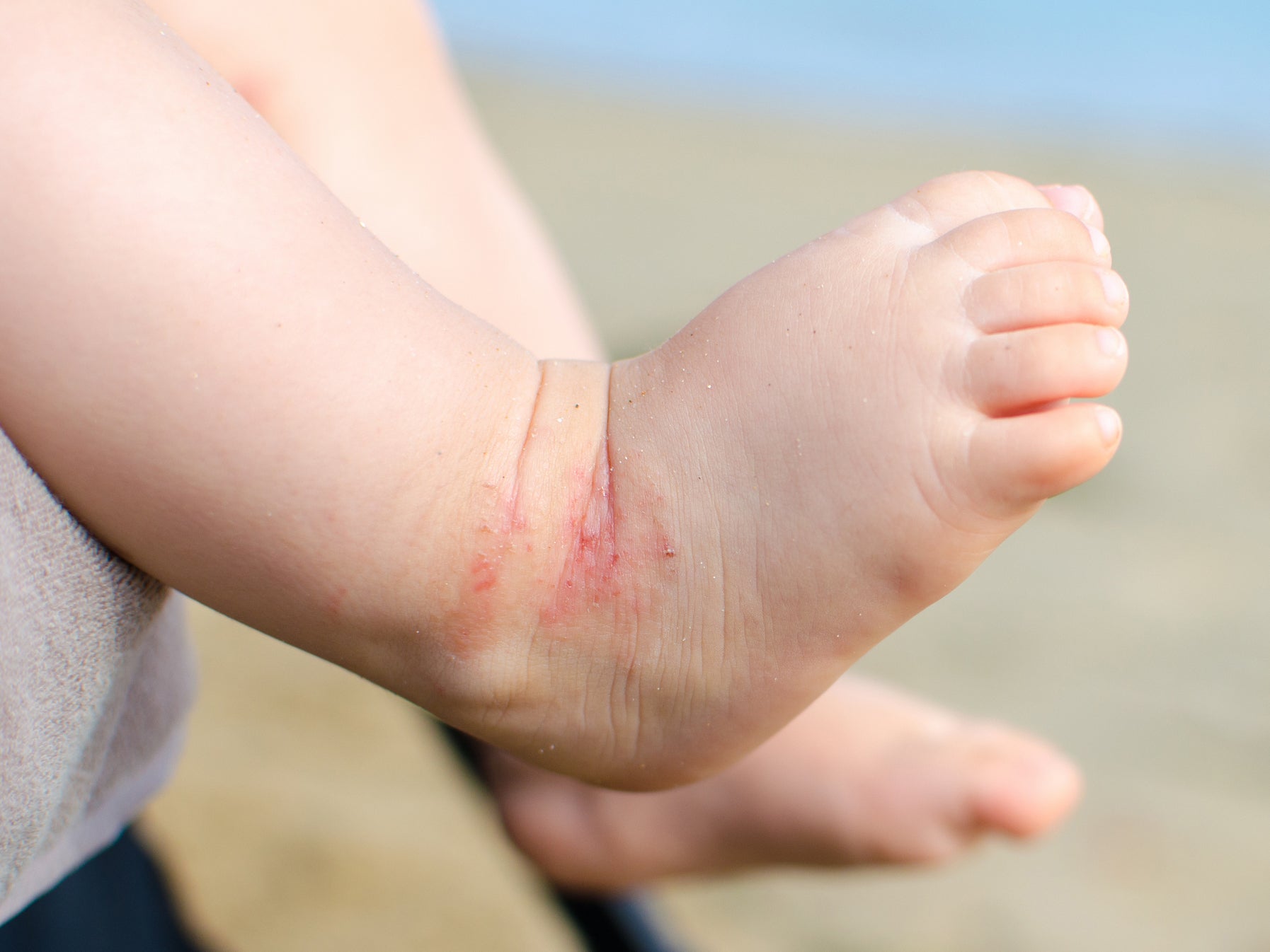 A 2025 study found a gene linked to eczema only increased the risk of eczema in children who hadn’t been exposed to dogs