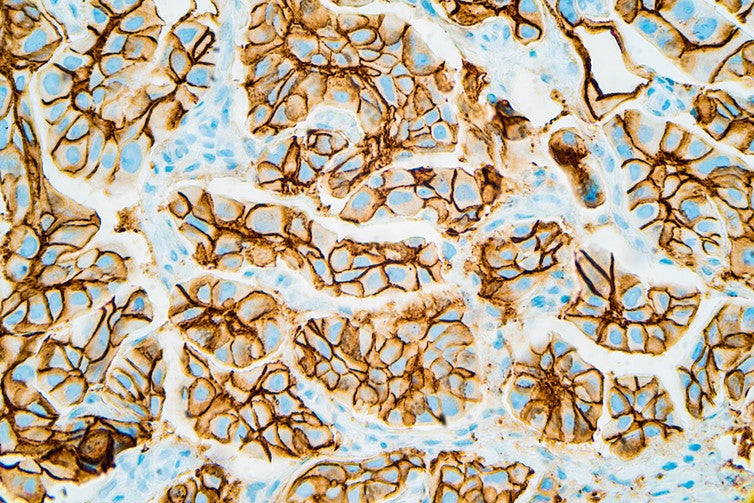 Cell membrane staining in?patients where HER2 is driving the cancer