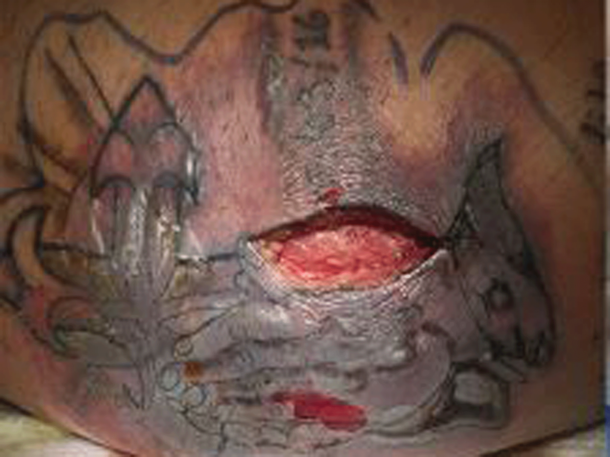 The patient's tattoo two weeks after infection