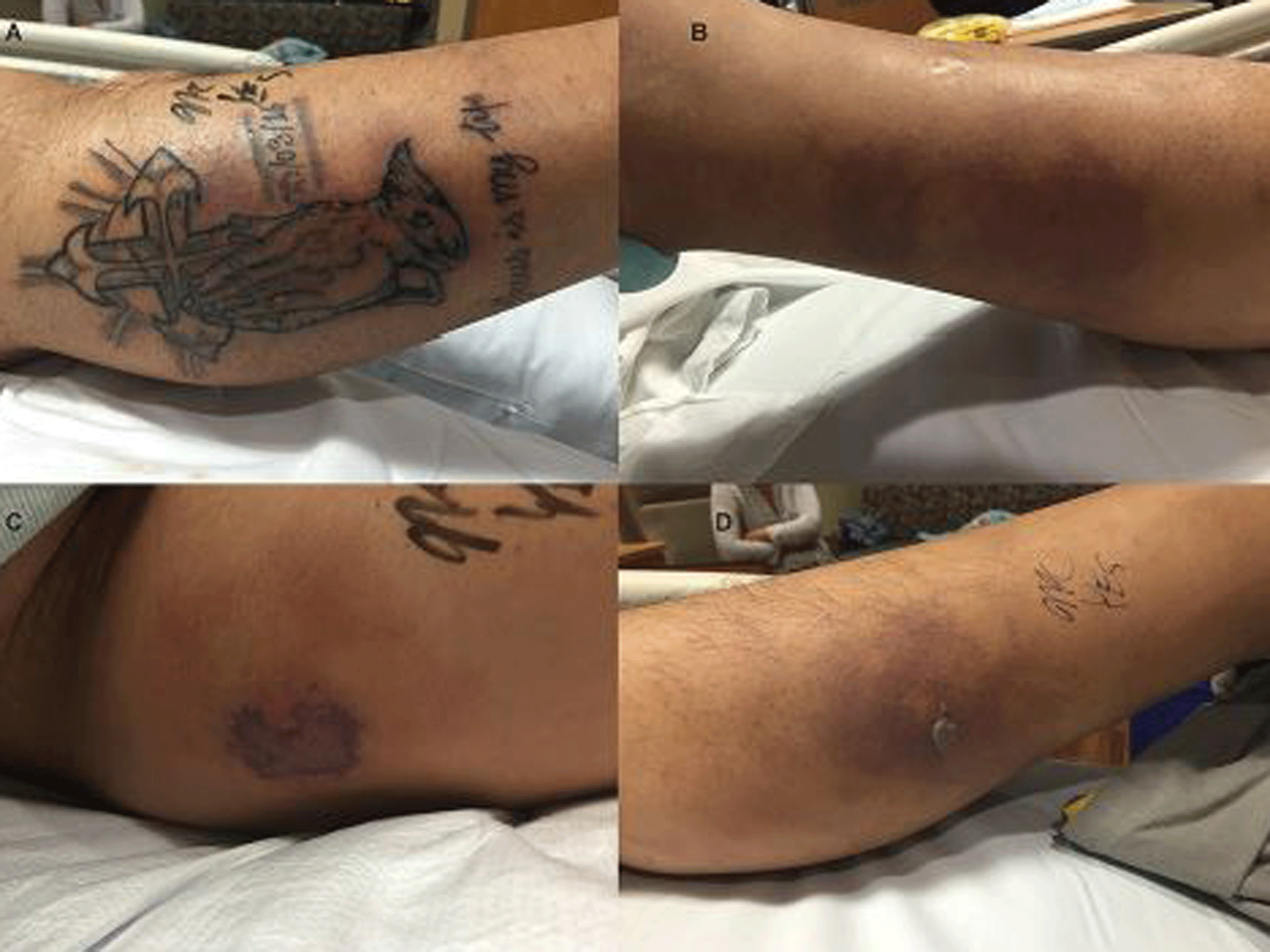 The patient's tattoo and skin lesions