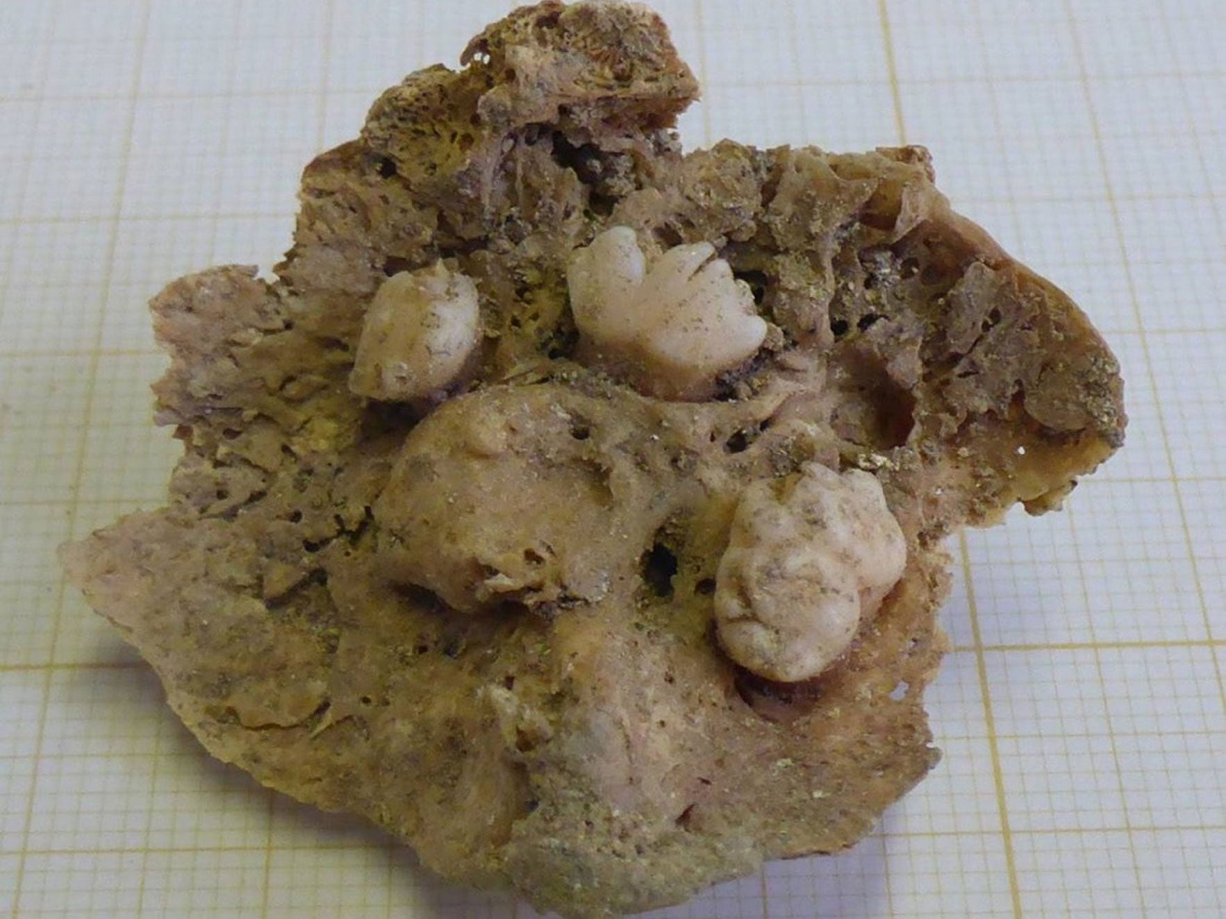 The tumour measured 4.3cm in width