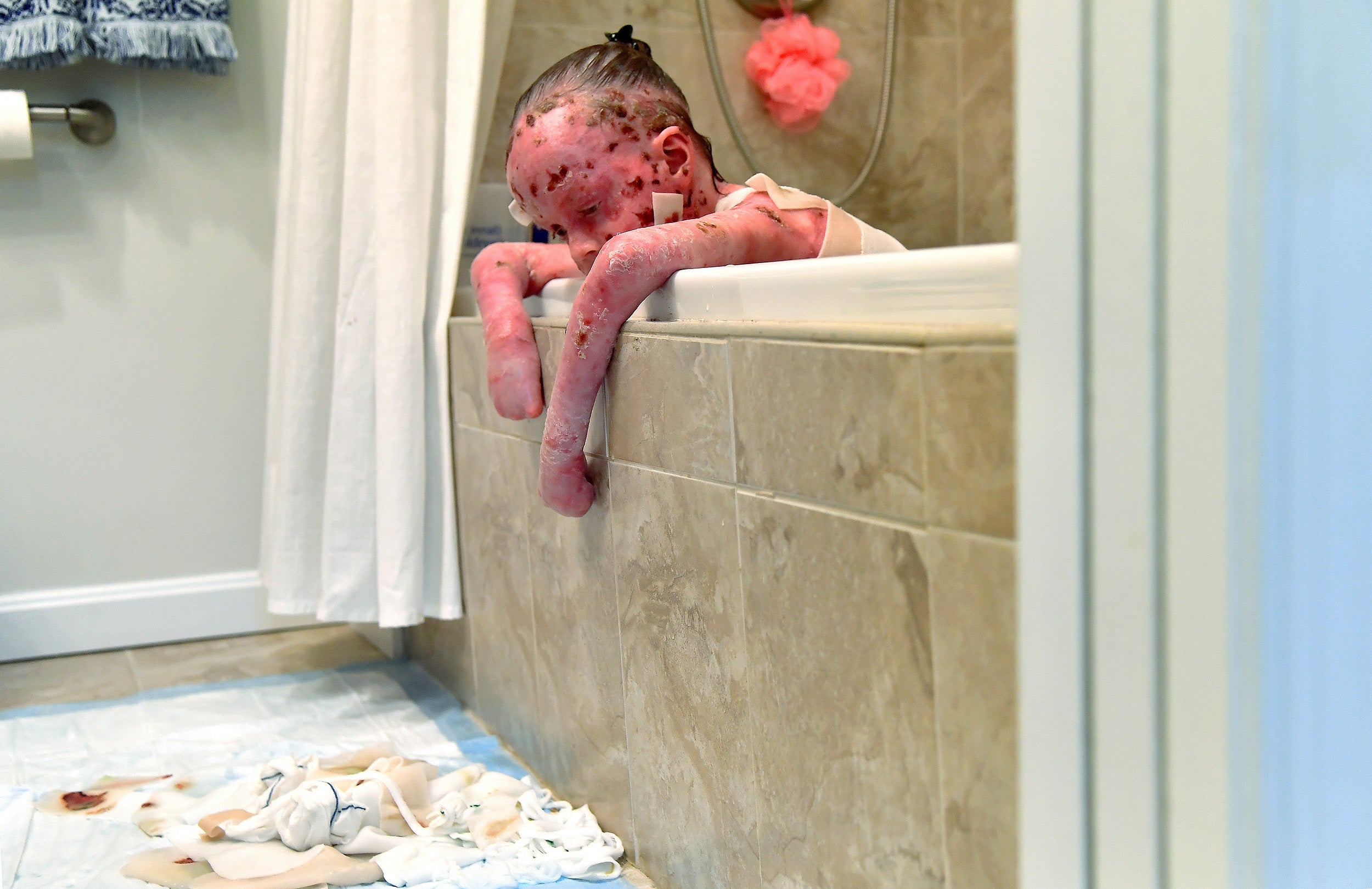 Ella pulls off her wound dressings in the bath