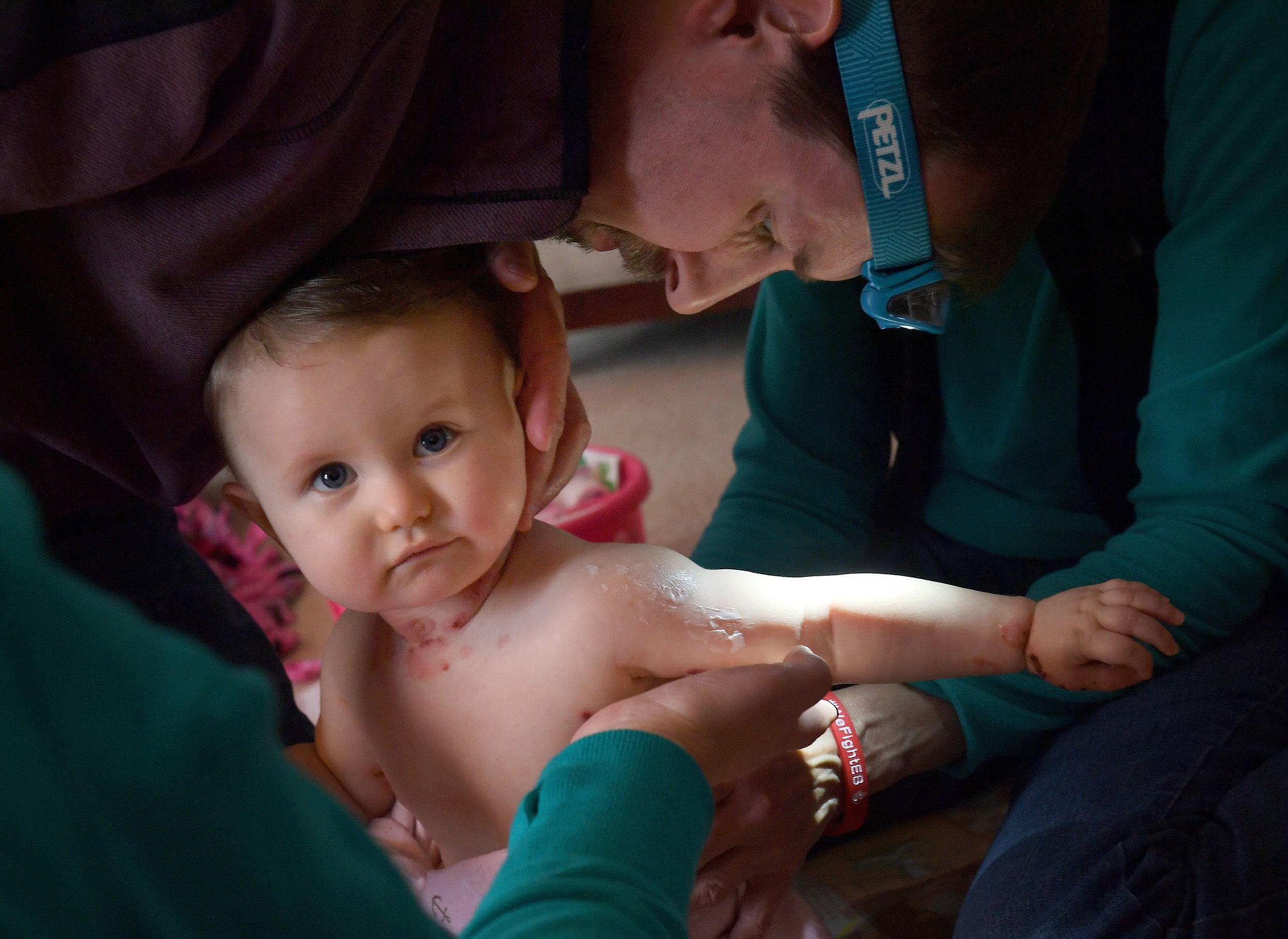 Kevin rubs cream over his daughters wounds – a twice-a-day ritual that can take three hours