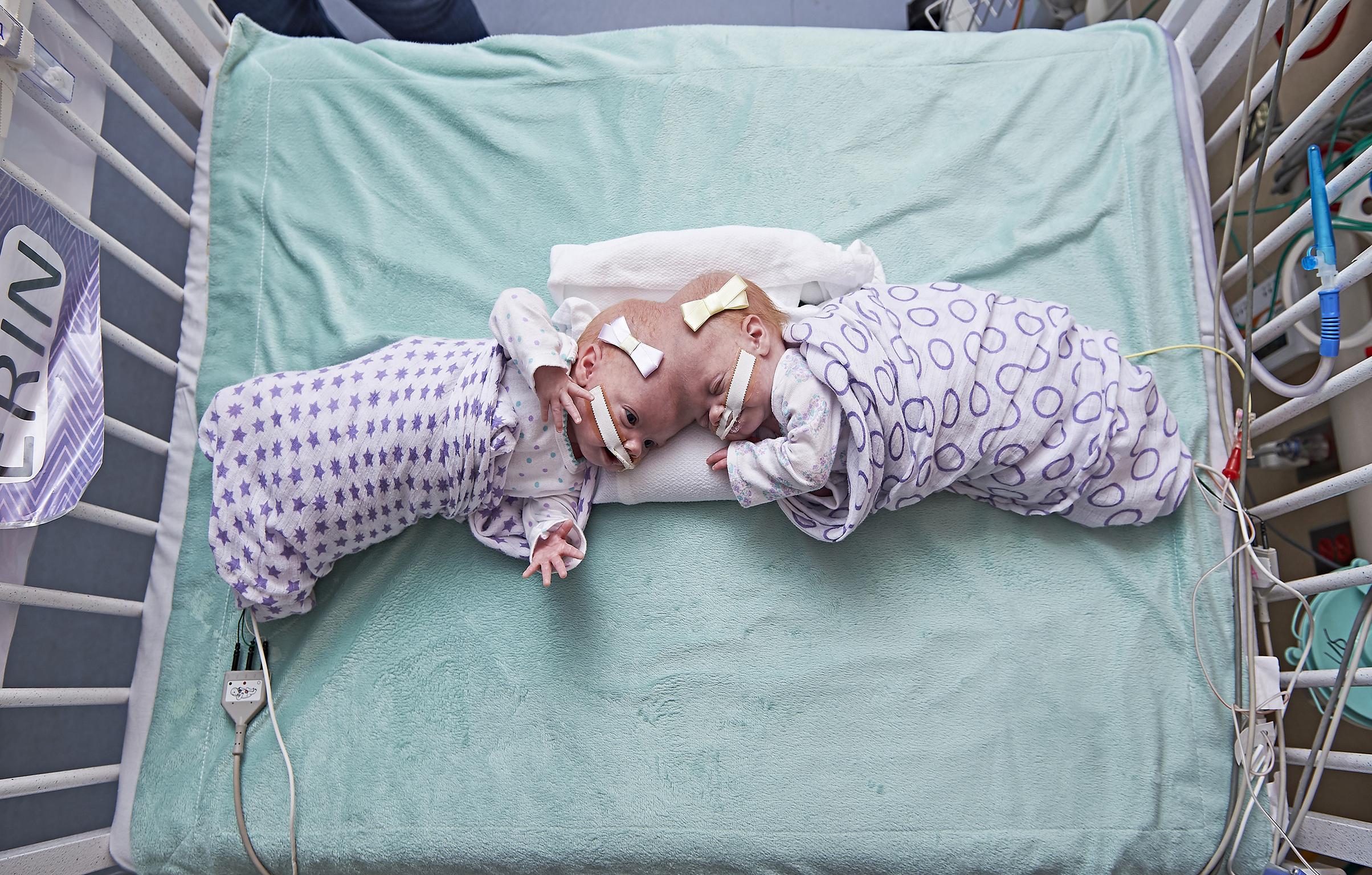 Twins Erin and Abby Delaney at the Children's Hospital of Philadelphia in September 2016