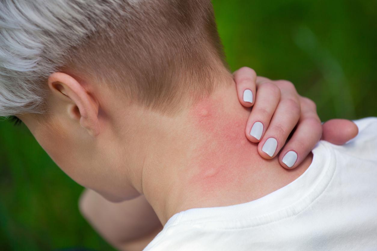A picada de mosquito geralmente vem por conta própria depois de três dias