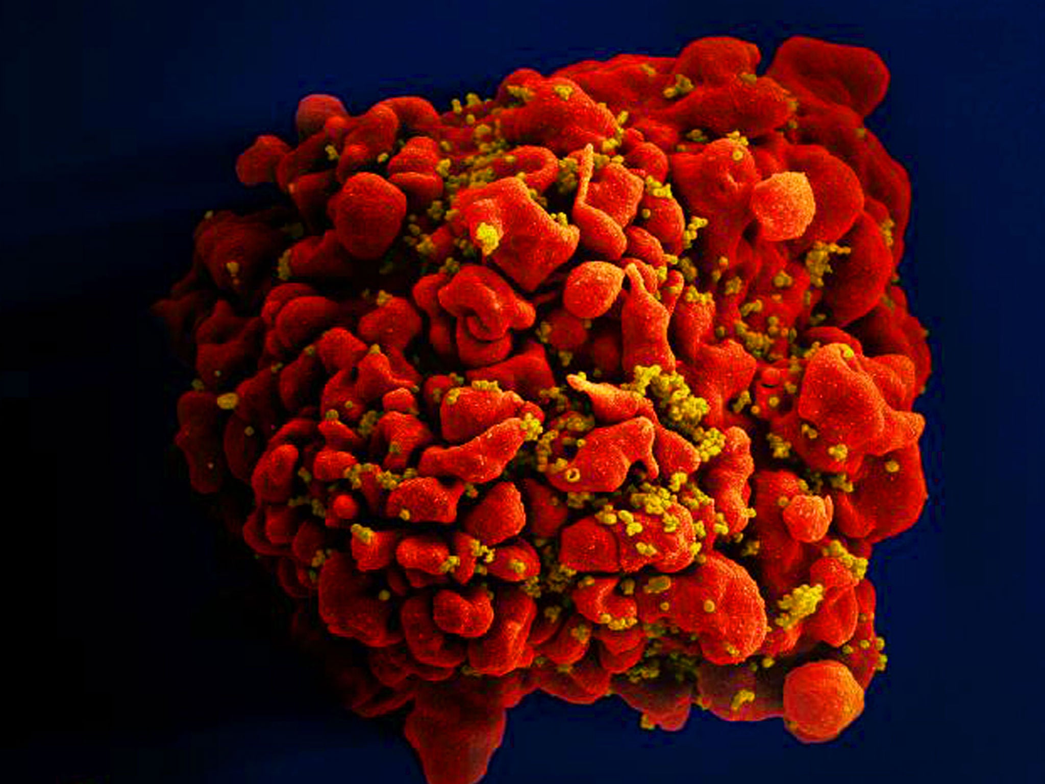 A cell infected by HIV particles