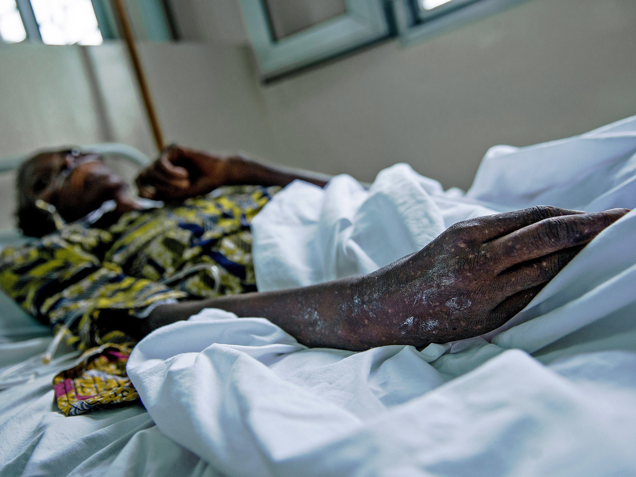 A patient is treated at the MSF HIV centre in the town of Lingala, Democratic Republic of Congo