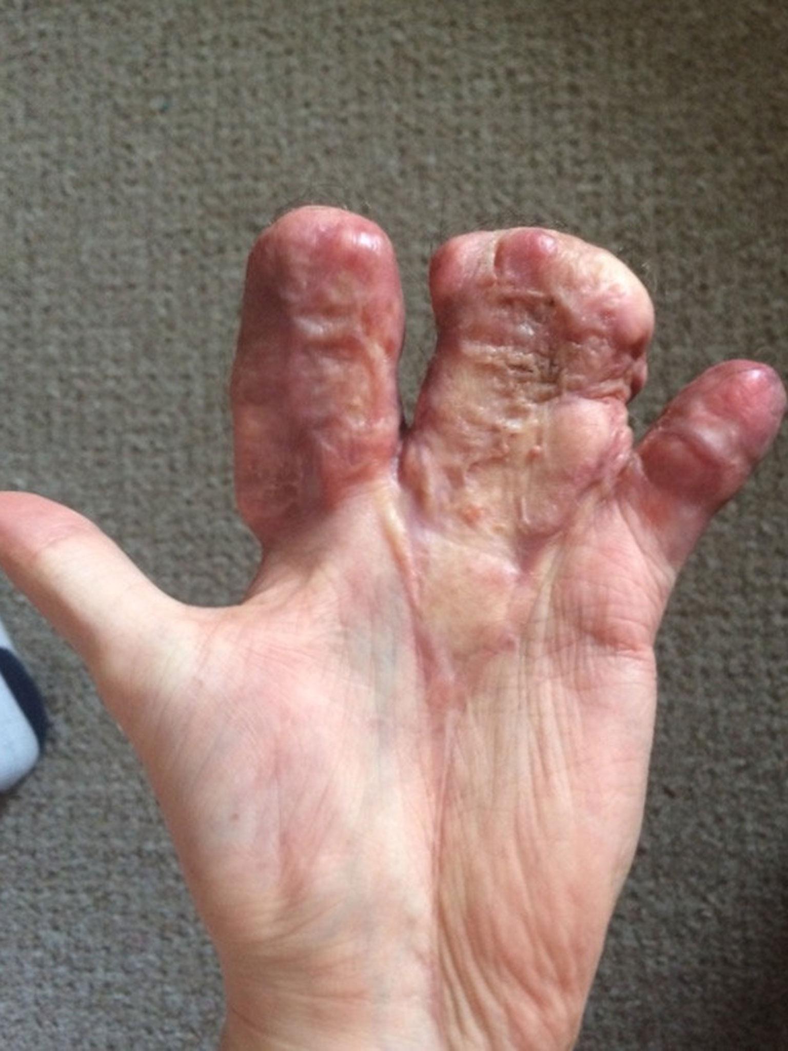 Mr Seward has since regained the partial use of his hand