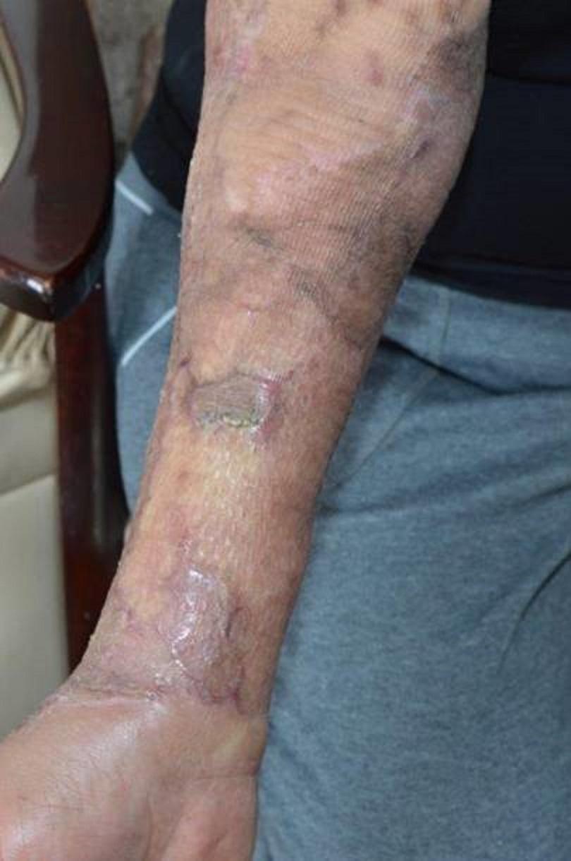 A 69-year-old woman was left permanently scarred by acid thrown by Whelan