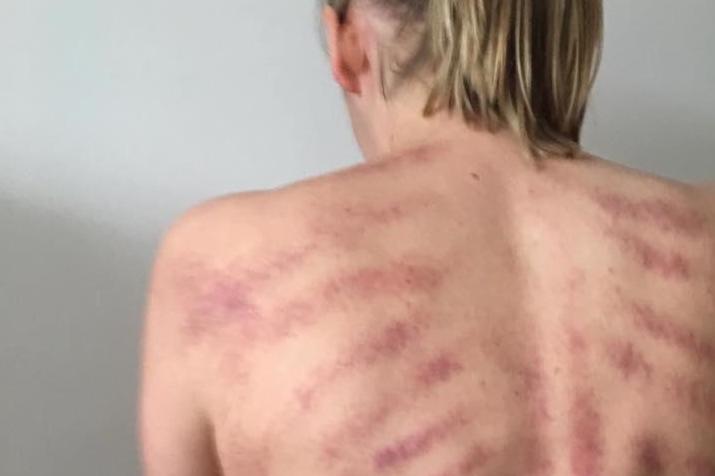 The woman's job was the root cause of her back problems