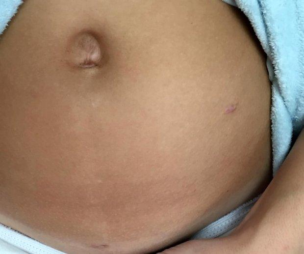 This close-up photo shows how her stomach is bloated