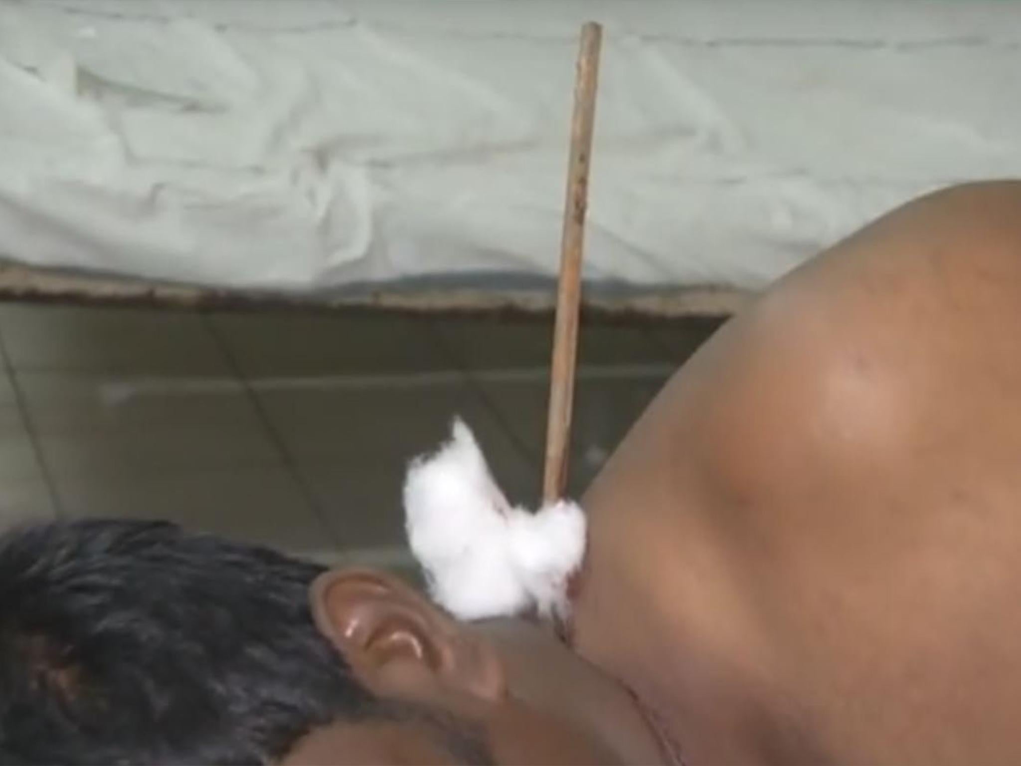 Surgeons were able to remove the rod from his neck and mouth