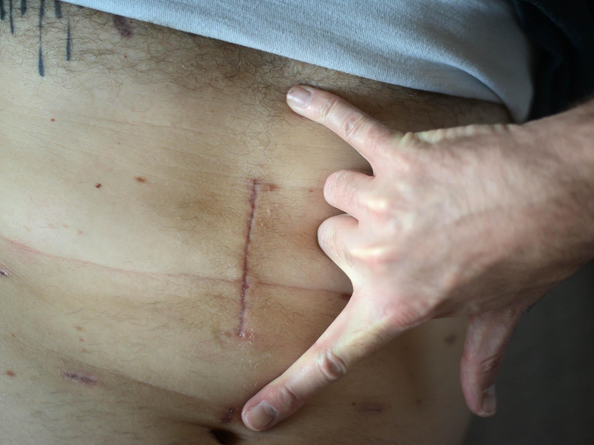 A scar from the surgery to remove David Fogel’s stomach