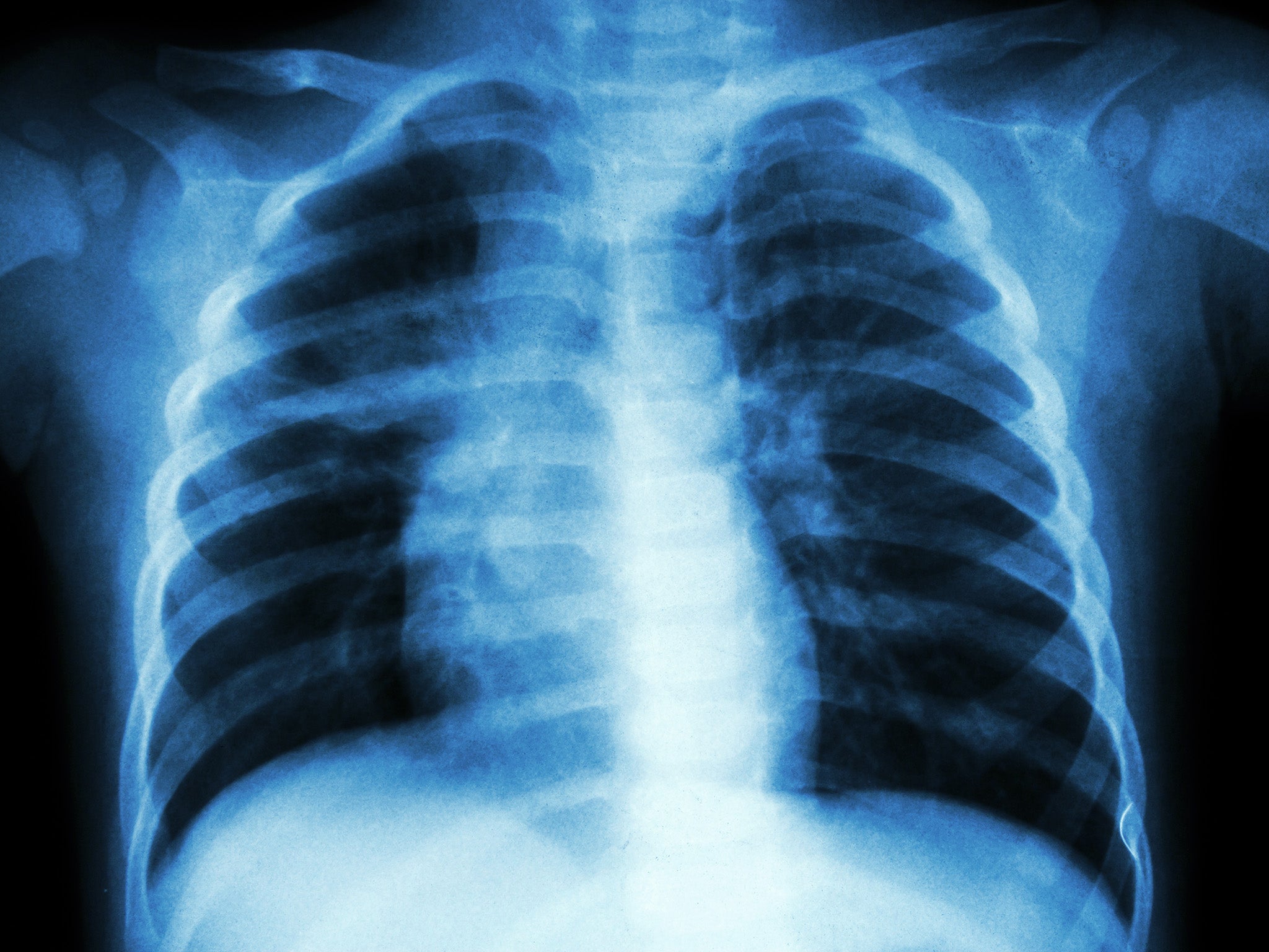 For decades, the bacterial infection has been confirmed by X-rays, which only detects advanced damage