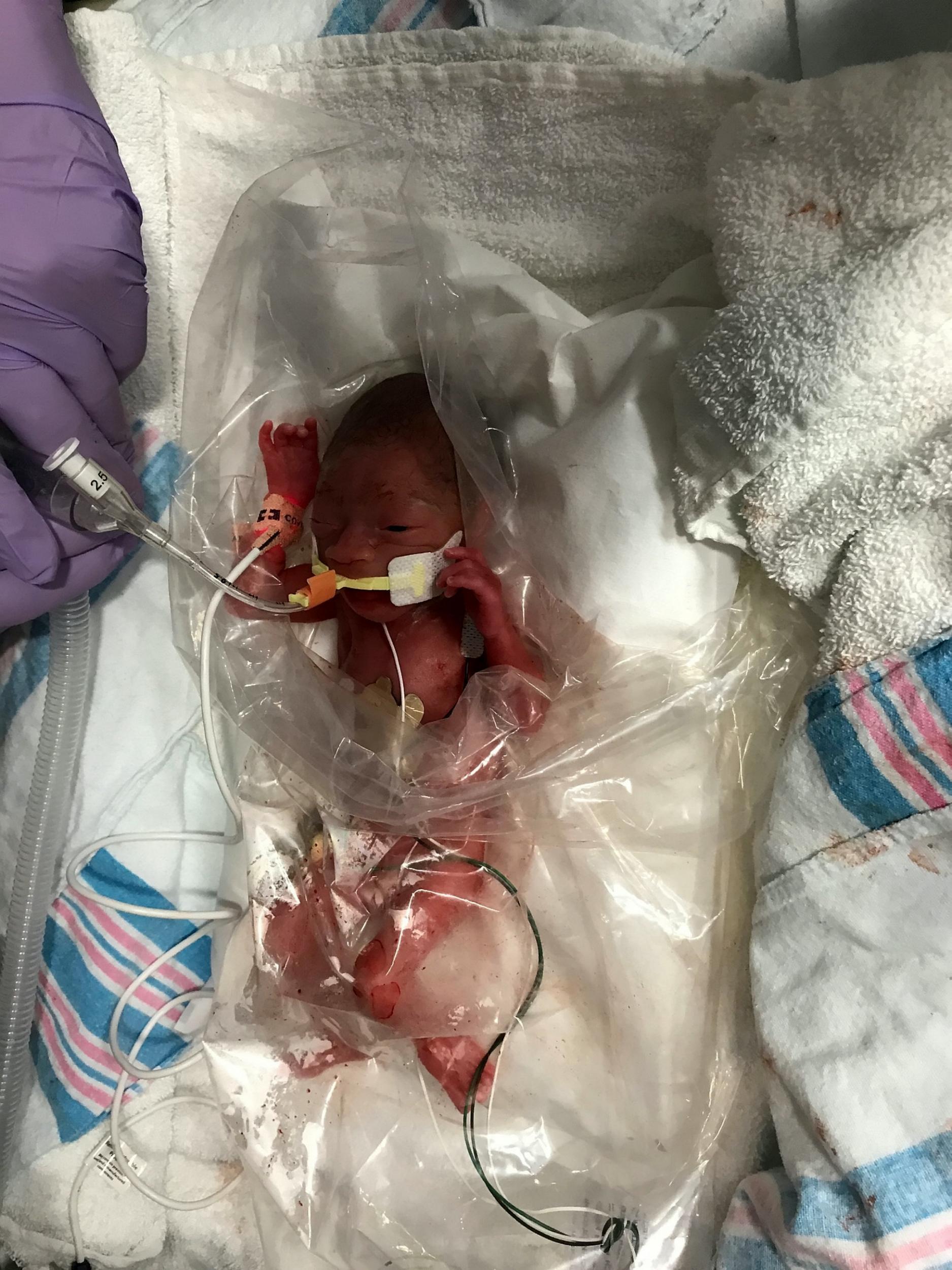 Baby Markcus was kept in a plastic bag to prevent him from getting hypothermia