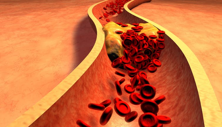 Lipoprotein particles shuttle cholesterol back and forth leaving plaque in their wake