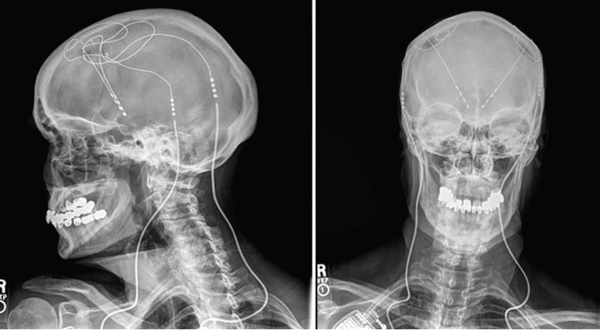 The 'pacemaker' device runs fine wires from a battery pack to the brain to stimulate the region responsible for decision making and planning