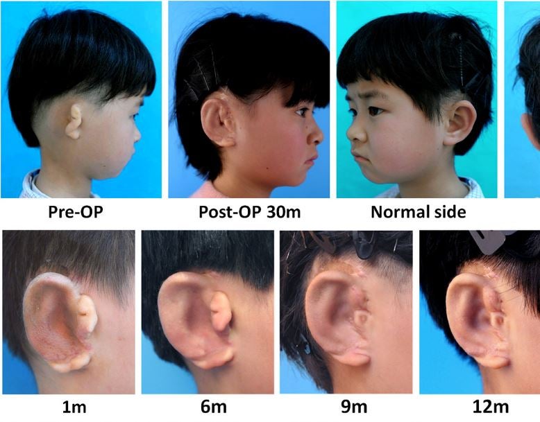 Cartilage cells taken from the recipient’s unaffected ear are grown on an artificial mould before it is grafted into place