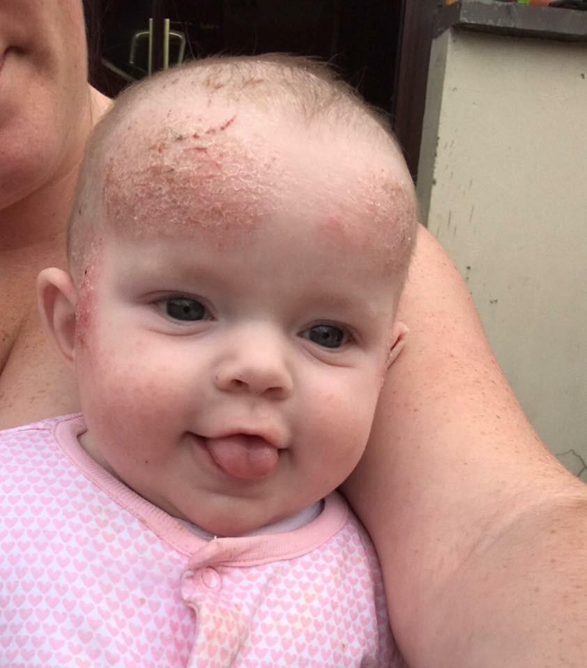 Joanne Nevin first noticed patches of eczema on Kelisha's skin when she was three months old