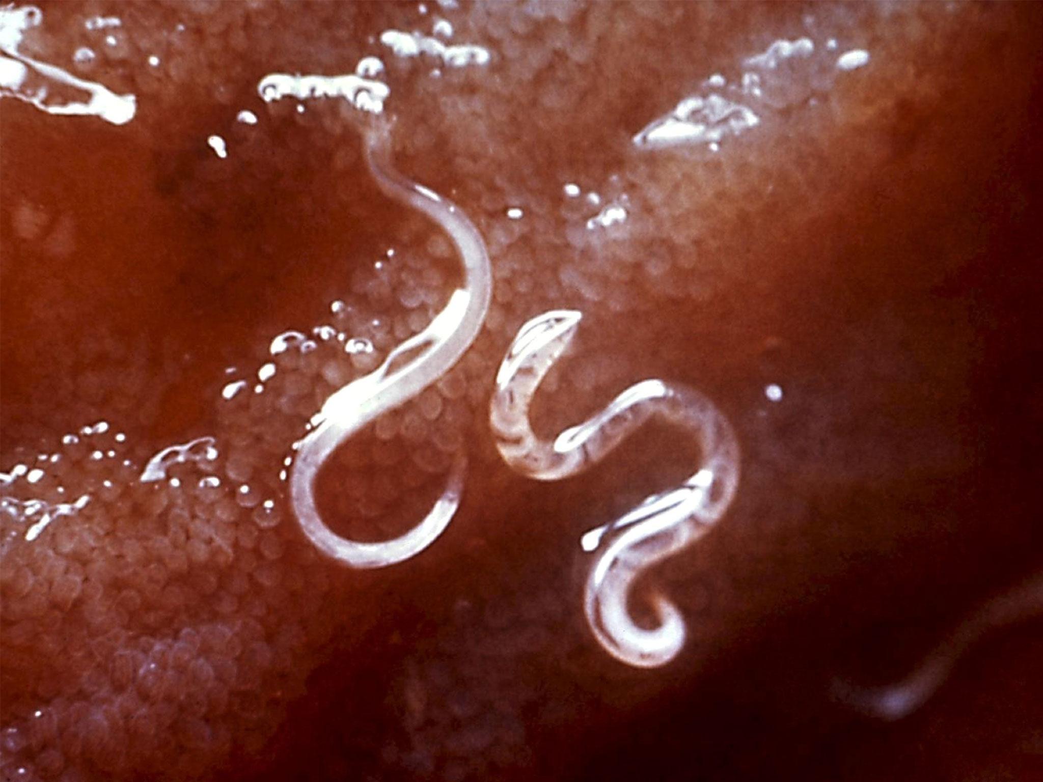 The pair believe they contracted the hookworm larvae parasite while sitting on a beach