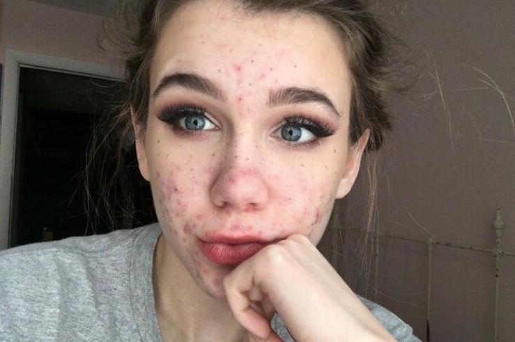 Emma O'Mahoney almost lost her eyesight from acne medication (Instagram)