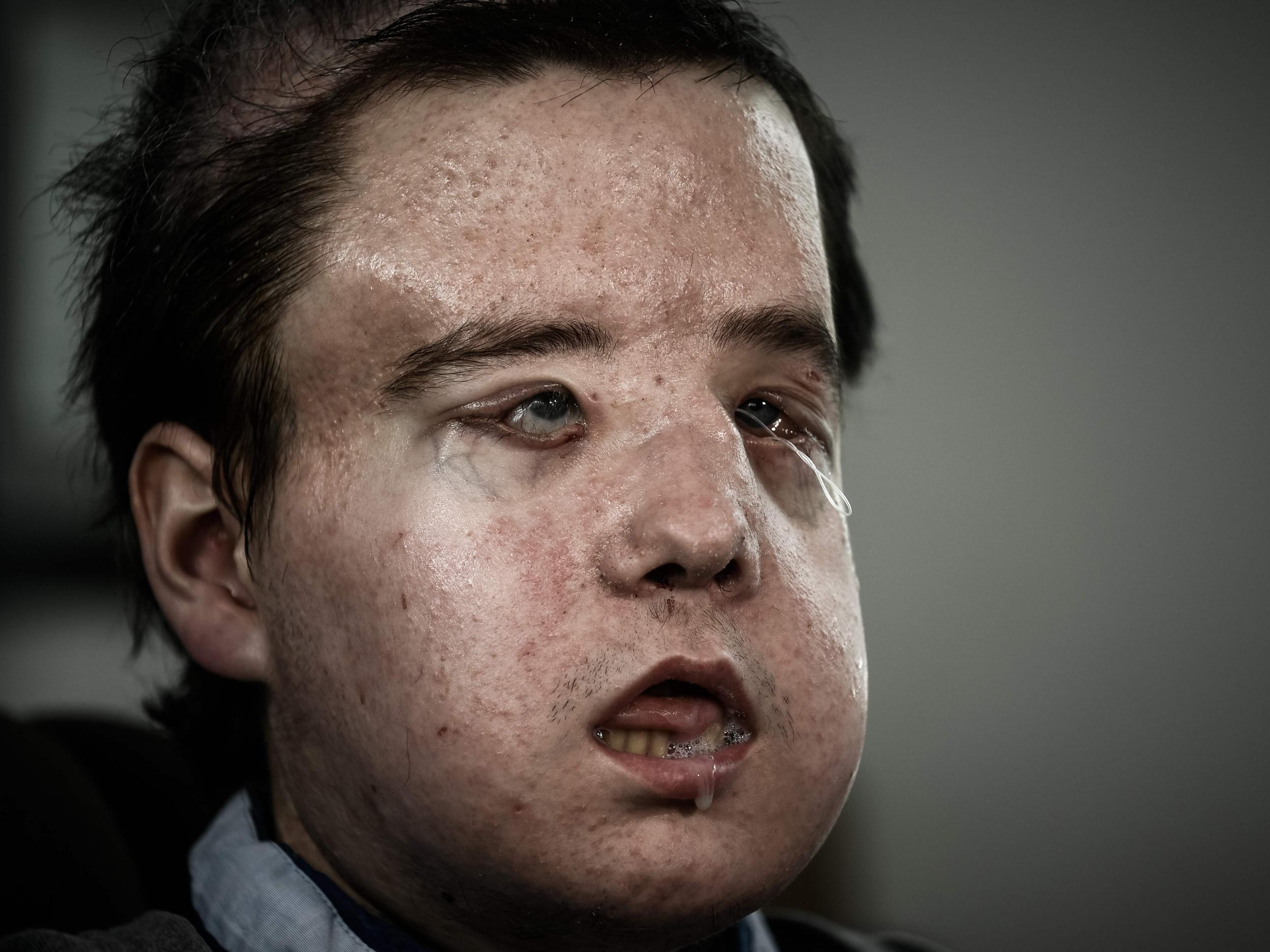 Jerome Hamon is the first person to undergo two face transplants