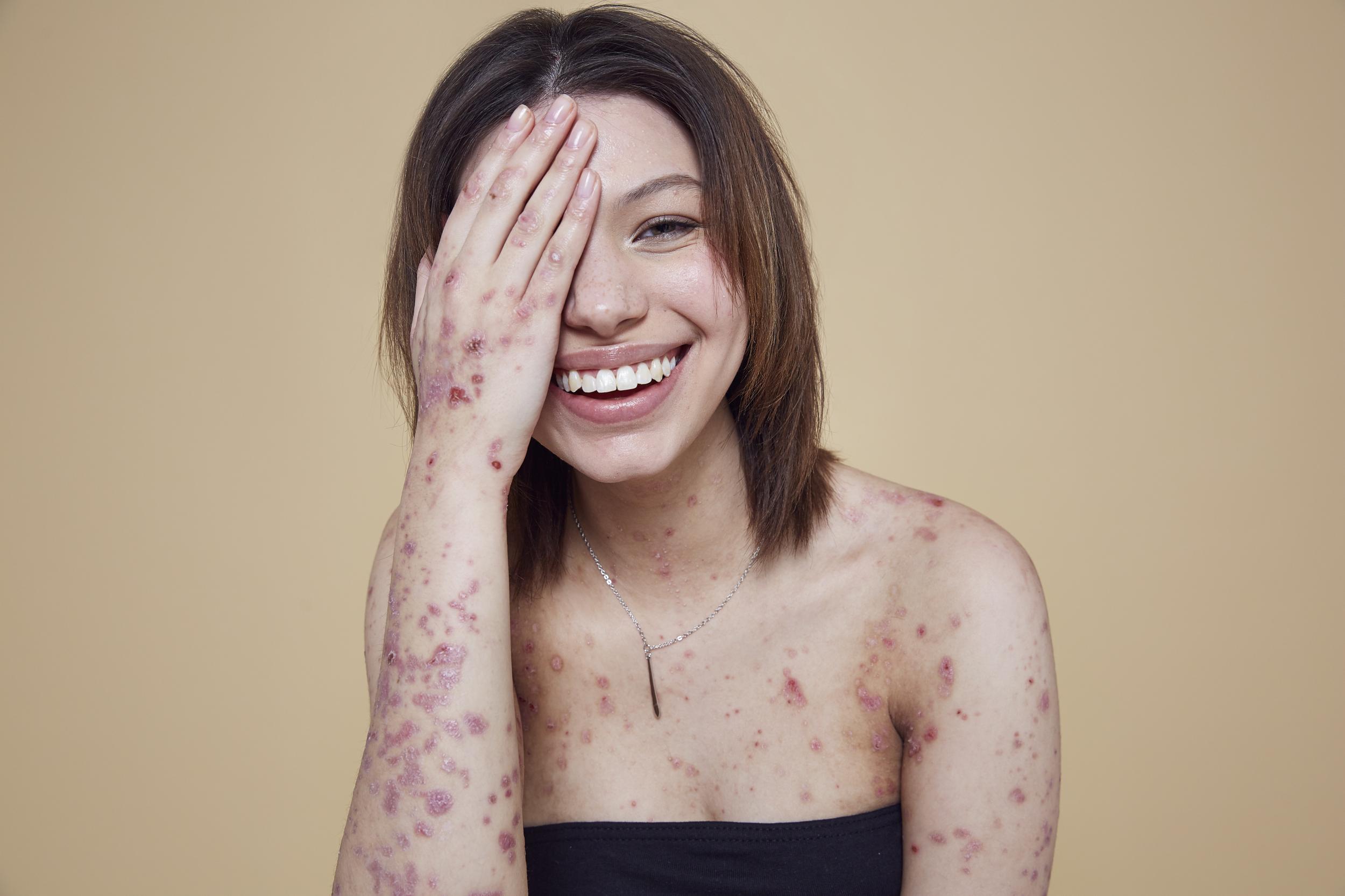 Maya hopes the campaign will help raise awareness of her rare skin condition