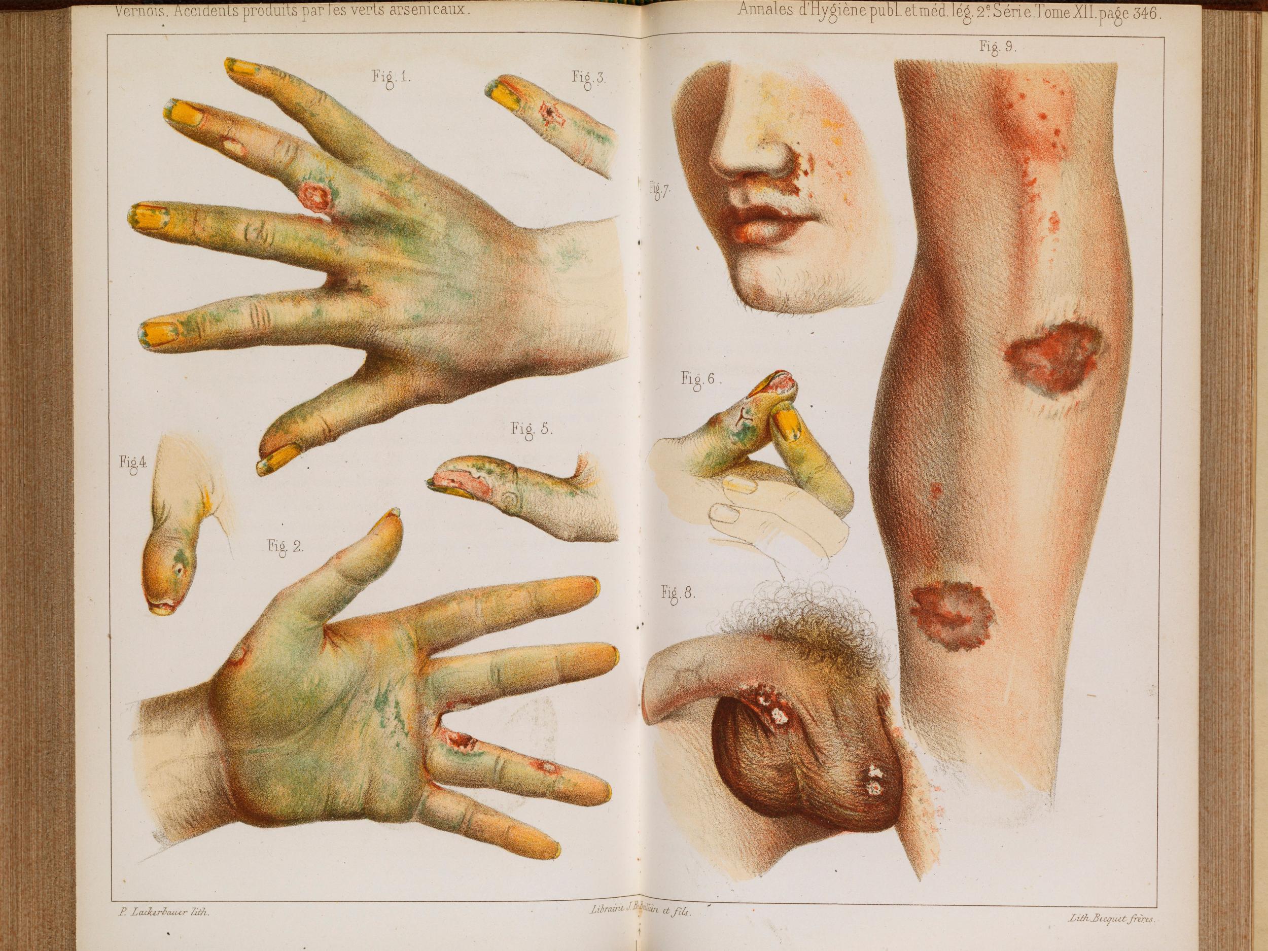 Damage caused by the use of green arsenic from a 1859 book