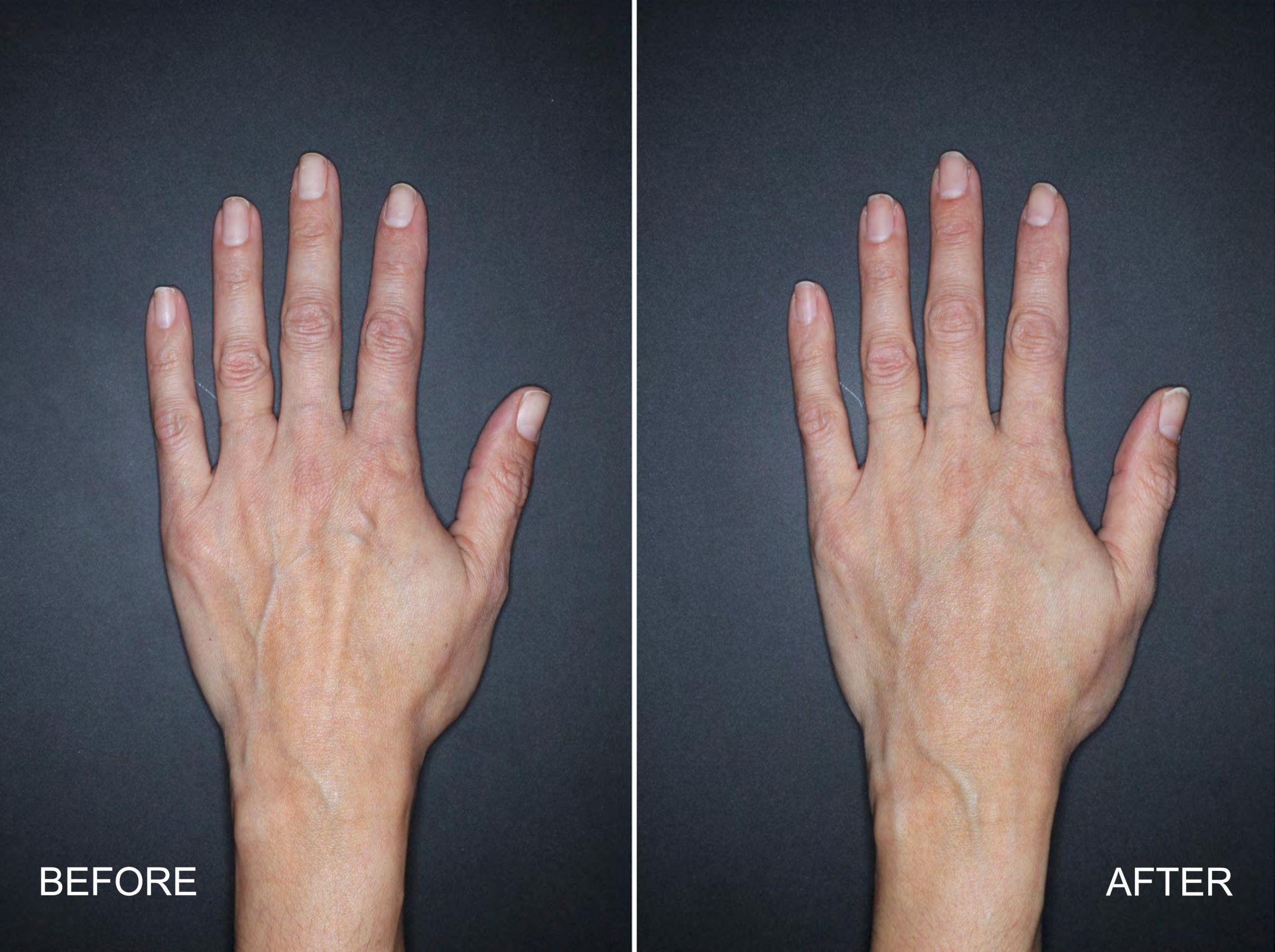 Men and women are getting hand injections (Nestlé Skin Health)