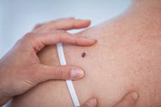 What is melanoma and what are the early signs of the skin cancer?