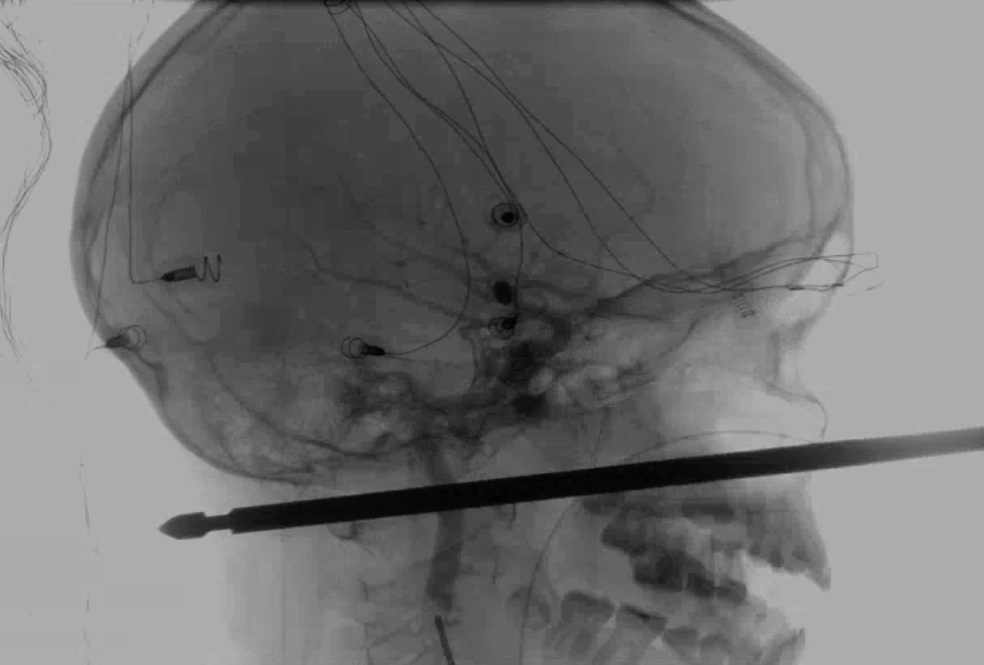 This X-ray provided by the Medical News Network shows a meat skewer impaled in the skull of Xavier Cunningham after an accident at his home Saturday, 8 September 2018, in Harrisonville, Mo.