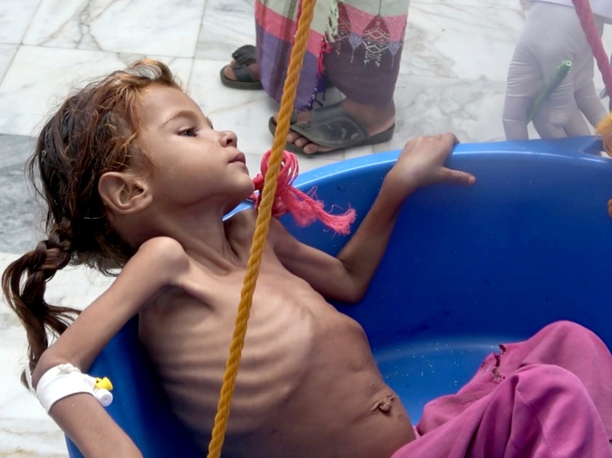 A severely malnourished girl is weighed at the Aslam Health Center in Hajjah, Yemen.