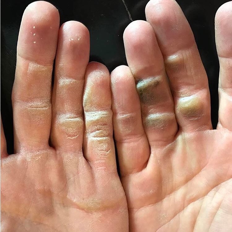 Golf has taken its toll on Alex Noren's hands