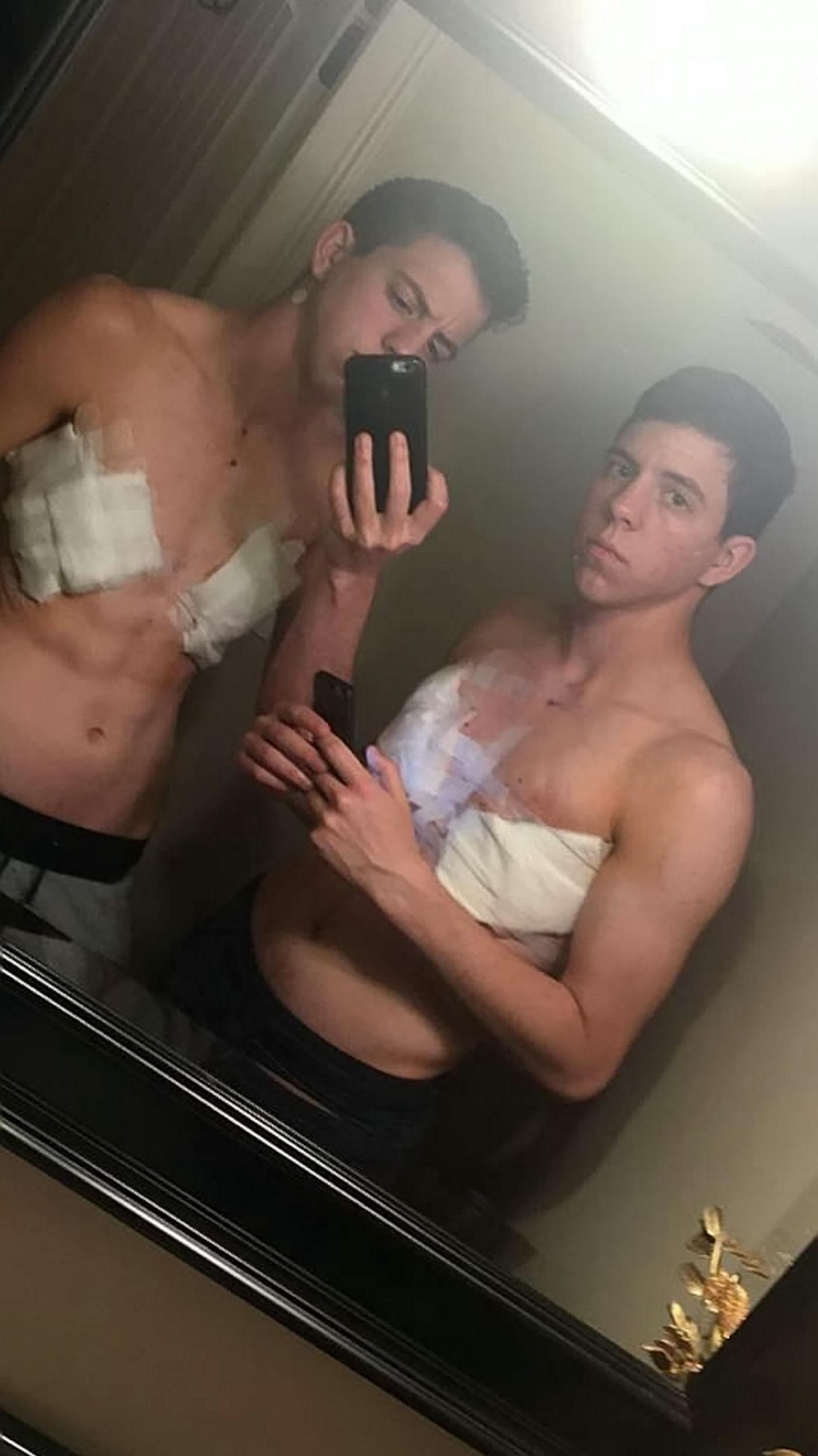 The brothers underwent chest surgery in August (SWNS)