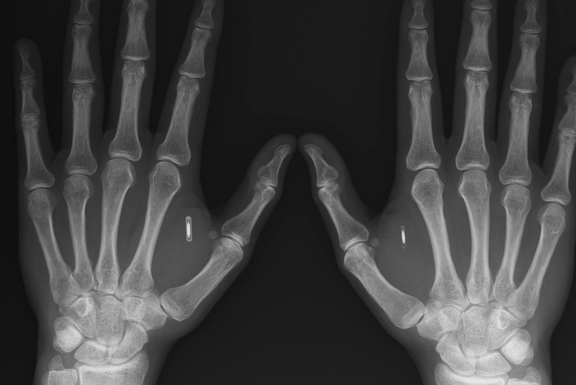 Swedish cyborg craze sees more than 4,000 Swedes insert chips under their skin