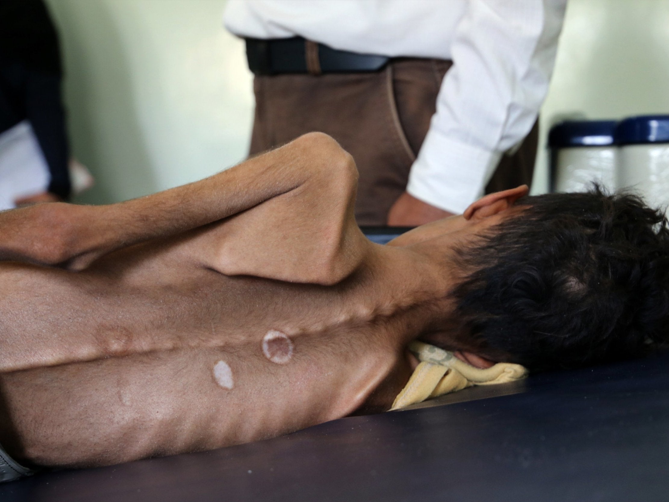 Yemeni boy Ghazi Ali bin Ali, 10, suffering from severe malnutrition lies on a bed in the outskirts of the city of Taiz, on 30 October 2018