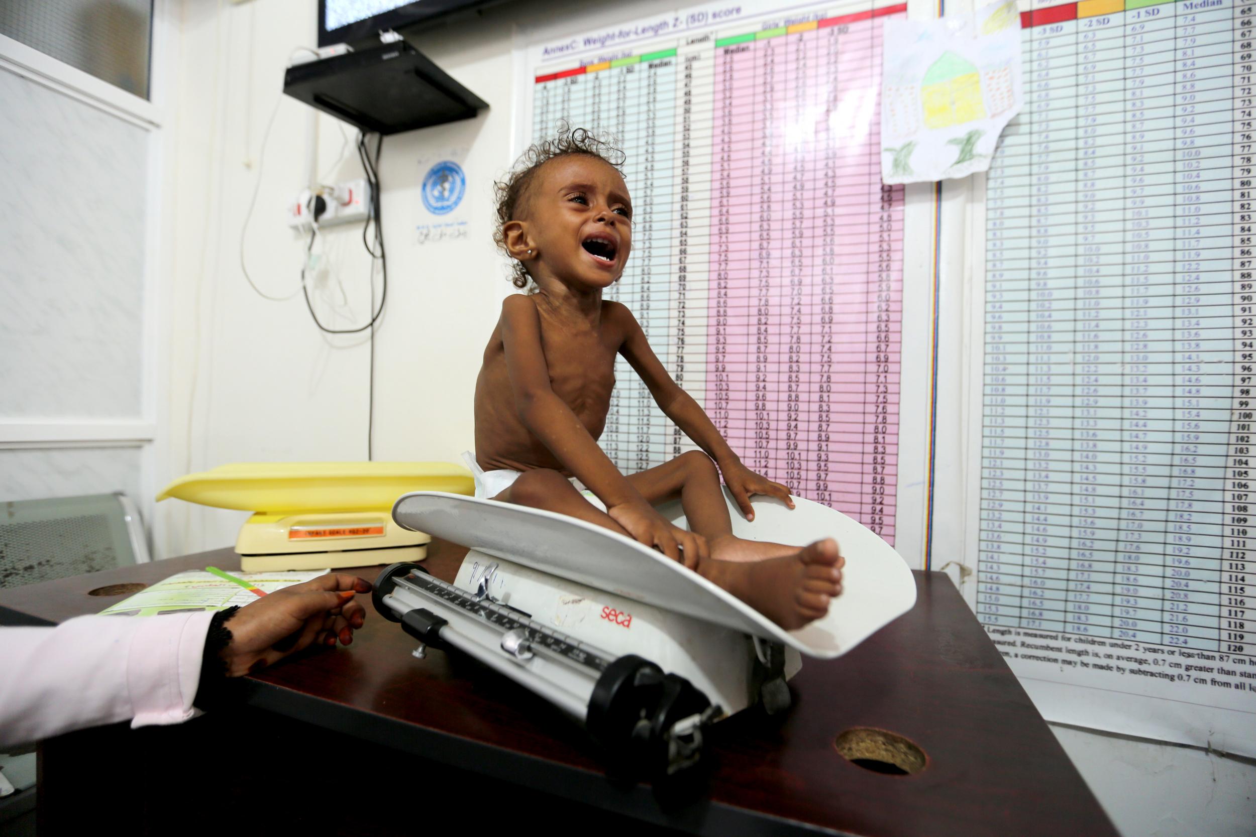 Malnourished Ferial Elias, 2, cries as she is being weighed at a malnutrition treatment ward at al-Thawra hospital in Hodeidah, Yemen